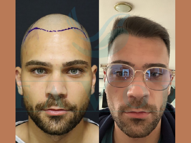 Как выбрать лучшую клинику по пересадке волос в Турции? ТОП-5 центров, где ESTE FAVOR лидирует благодаря Искусственному Интеллекту и Сапфировой FUE